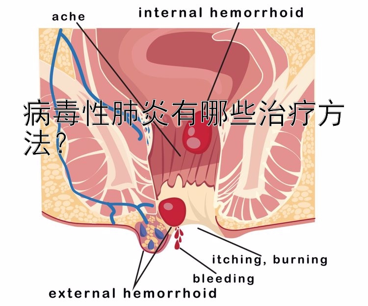 病毒性肺炎有哪些治疗方法？