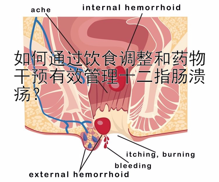 如何通过饮食调整和药物干预有效管理十二指肠溃疡？