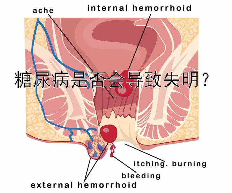 糖尿病是否会导致失明？