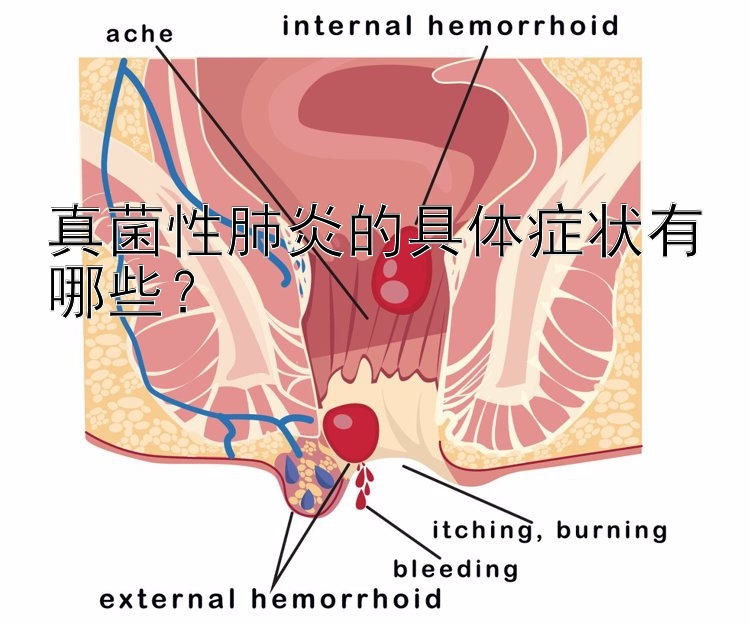 真菌性肺炎的具体症状有哪些？