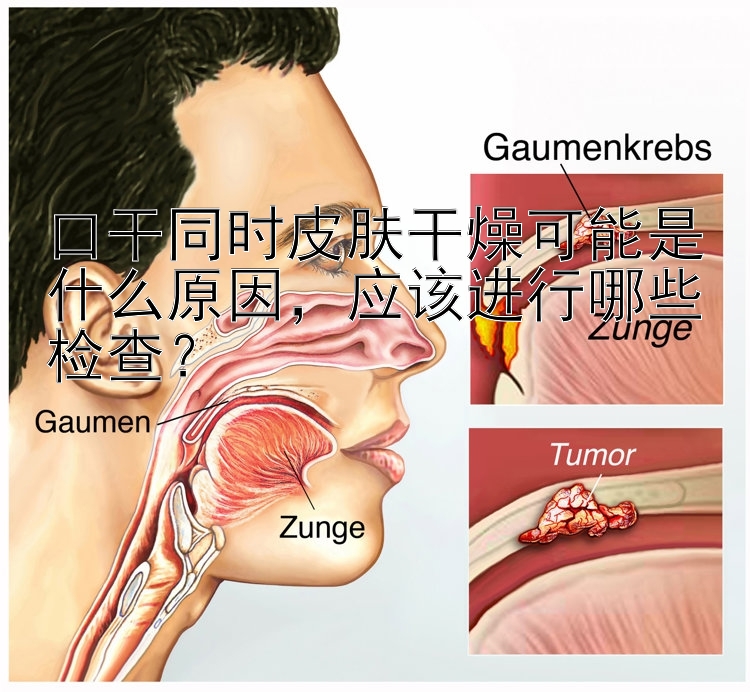 口干同时皮肤干燥可能是什么原因，应该进行哪些检查？