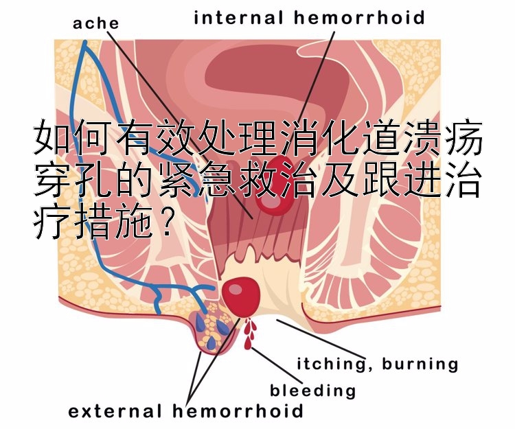 如何有效处理消化道溃疡穿孔的紧急救治及跟进治疗措施？