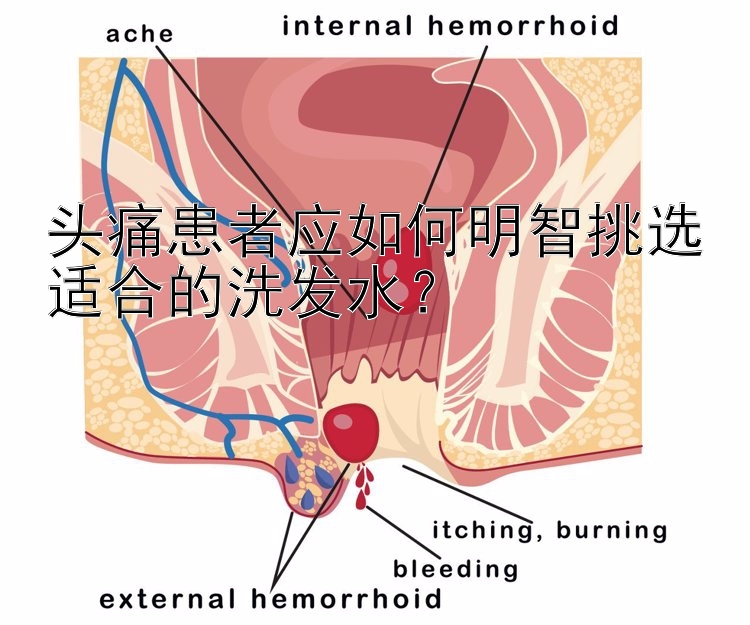 头痛患者应如何明智挑选适合的洗发水？