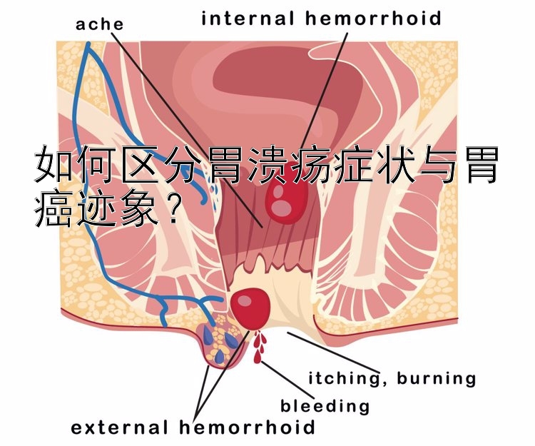 如何区分胃溃疡症状与胃癌迹象？