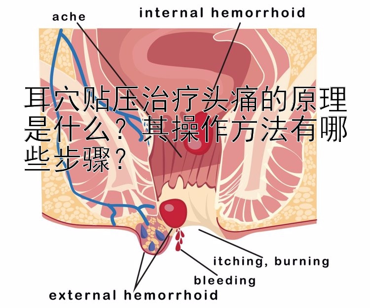 耳穴贴压治疗头痛的原理是什么？其操作方法有哪些步骤？