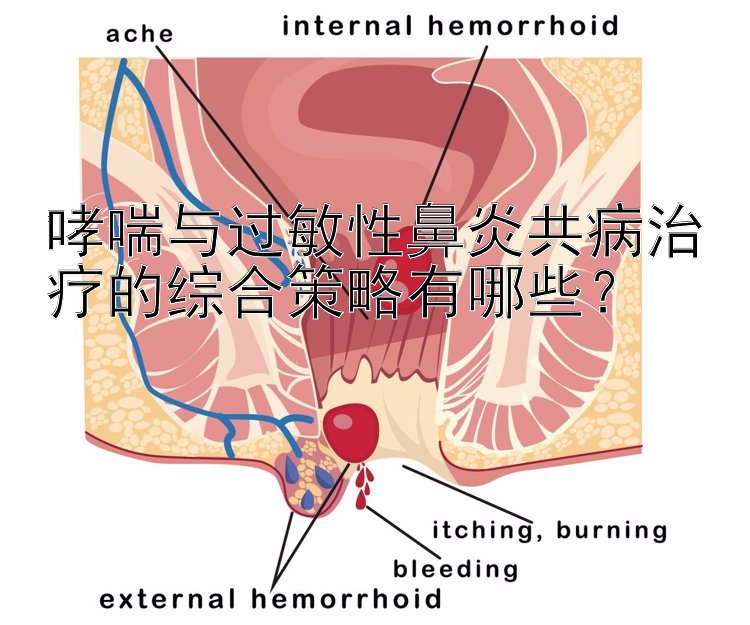 哮喘与过敏性鼻炎共病治疗的综合策略有哪些？