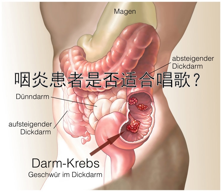 咽炎患者是否适合唱歌？