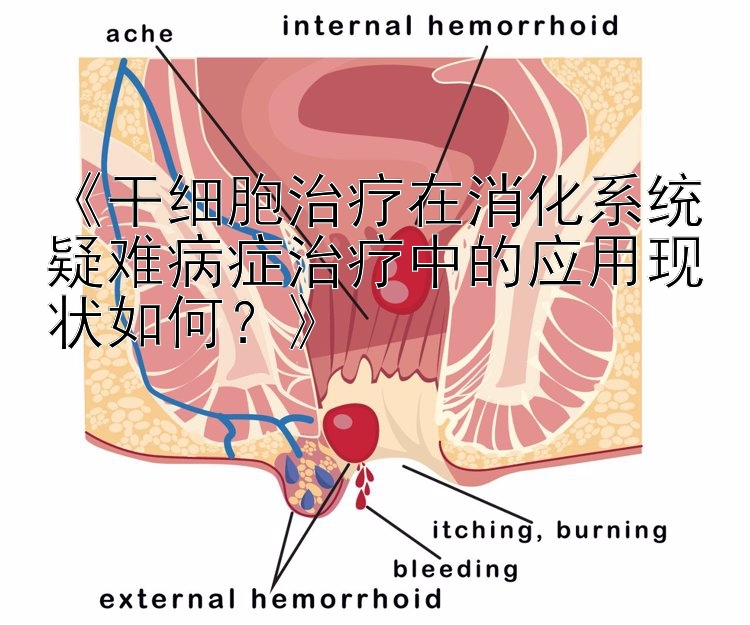 《干细胞治疗在消化系统疑难病症治疗中的应用现状如何？》