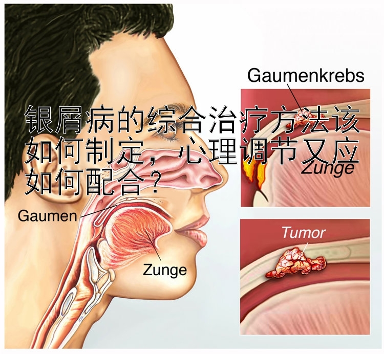 银屑病的综合治疗方法该如何制定，心理调节又应如何配合？